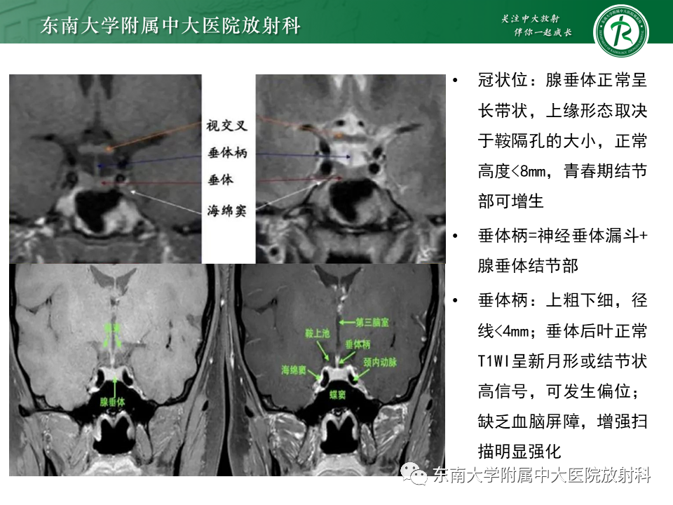 影像PPT - 【PPT】垂体细胞瘤-10