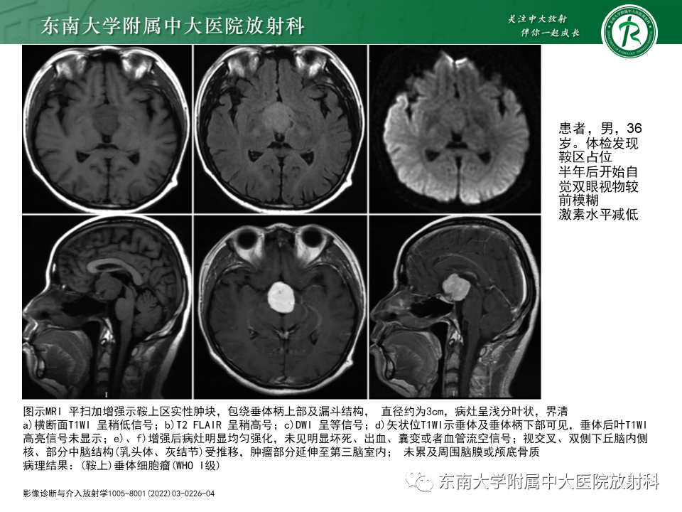 影像PPT - 【PPT】垂体细胞瘤-17
