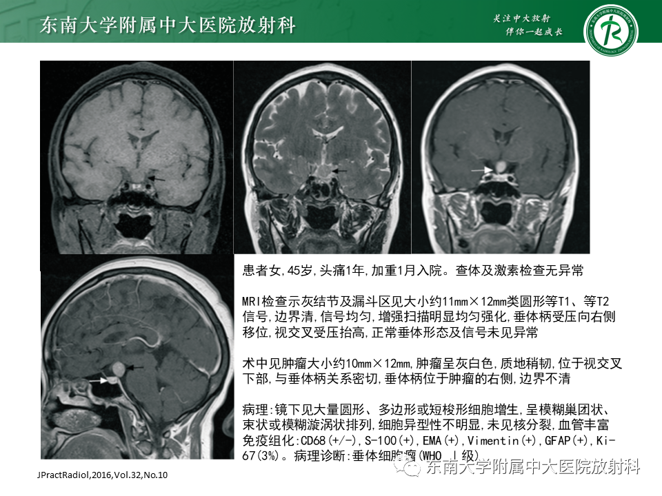影像PPT - 【PPT】垂体细胞瘤-18