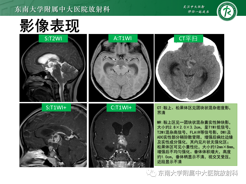影像PPT - 【PPT】垂体细胞瘤-22