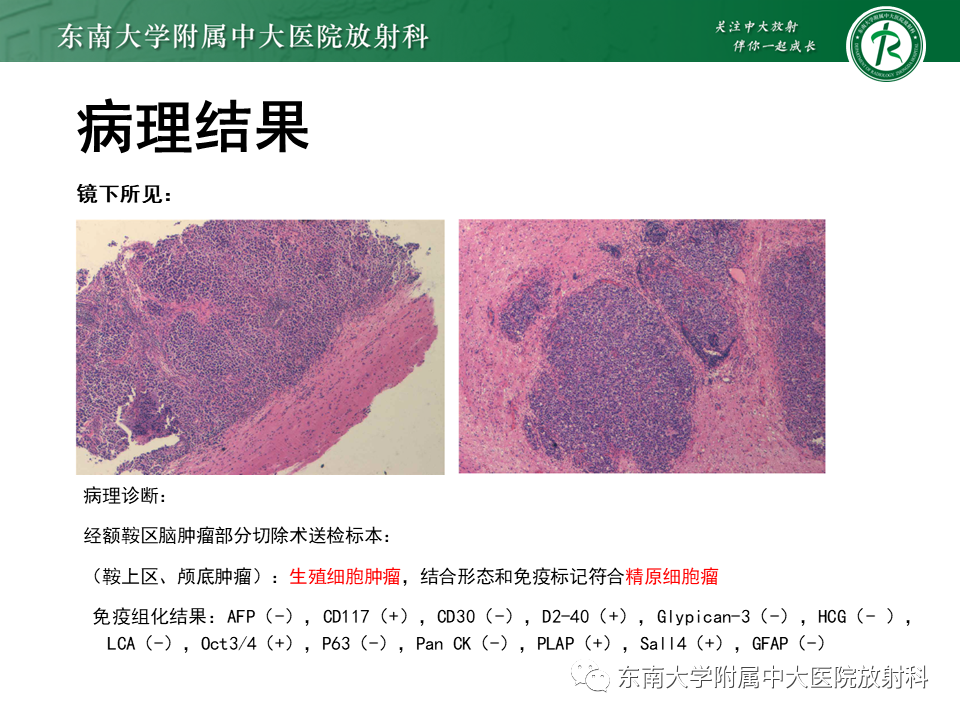 影像PPT - 【PPT】垂体细胞瘤-23