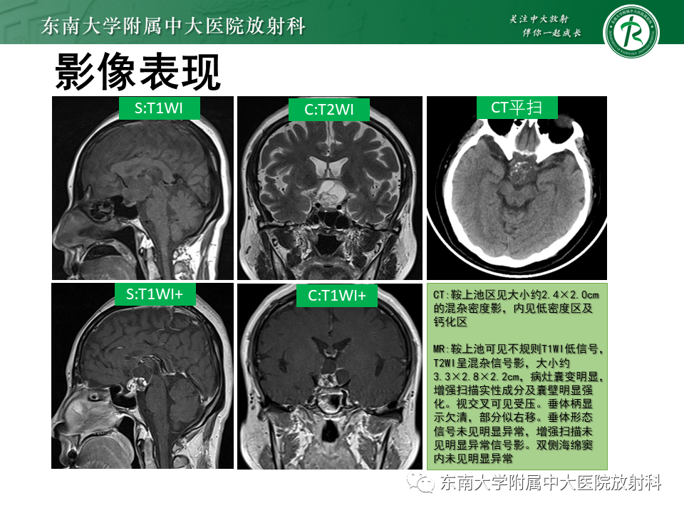 影像PPT - 【PPT】垂体细胞瘤-28