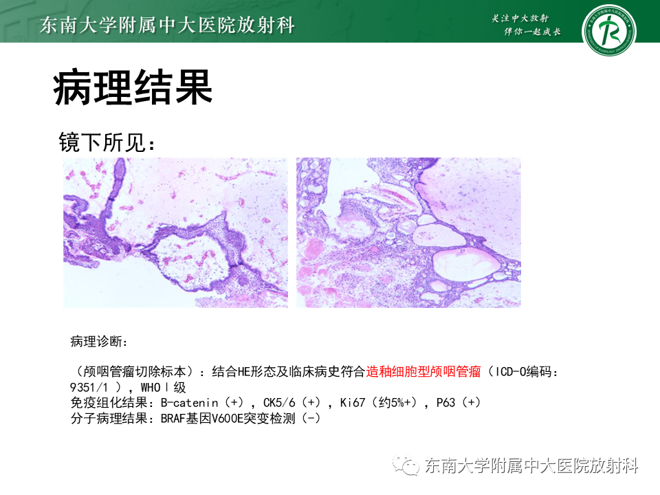 影像PPT - 【PPT】垂体细胞瘤-29