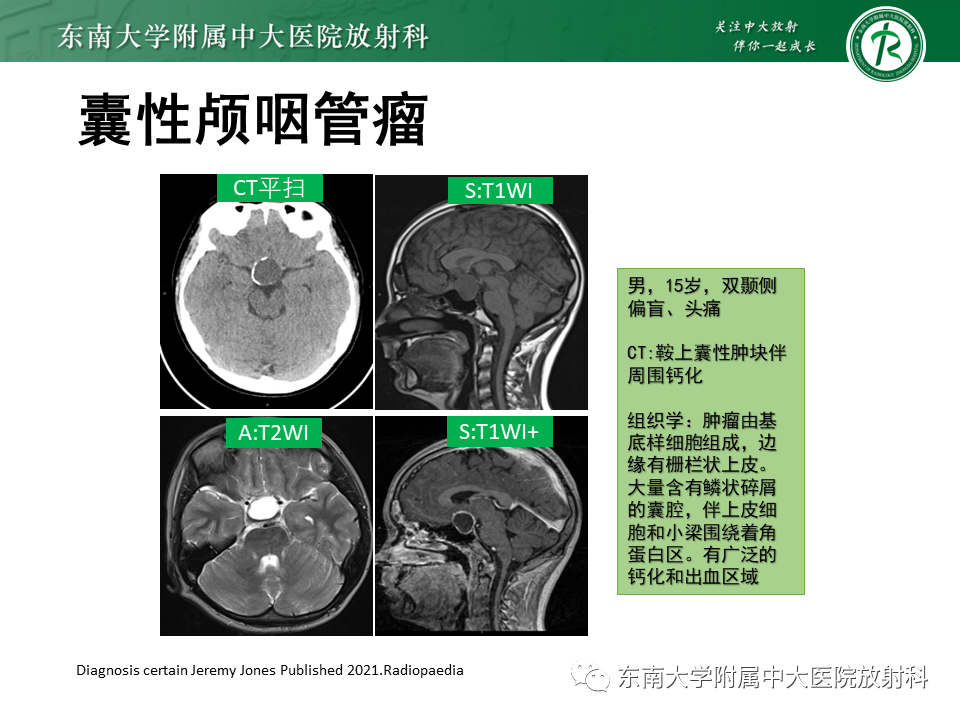 影像PPT - 【PPT】垂体细胞瘤-35