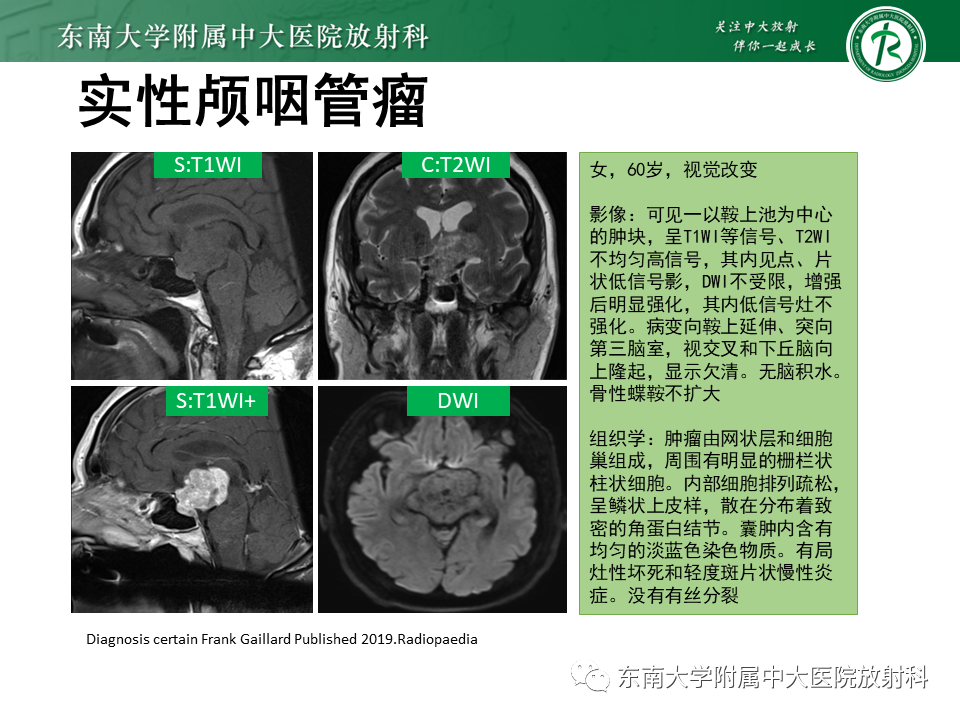 影像PPT - 【PPT】垂体细胞瘤-36