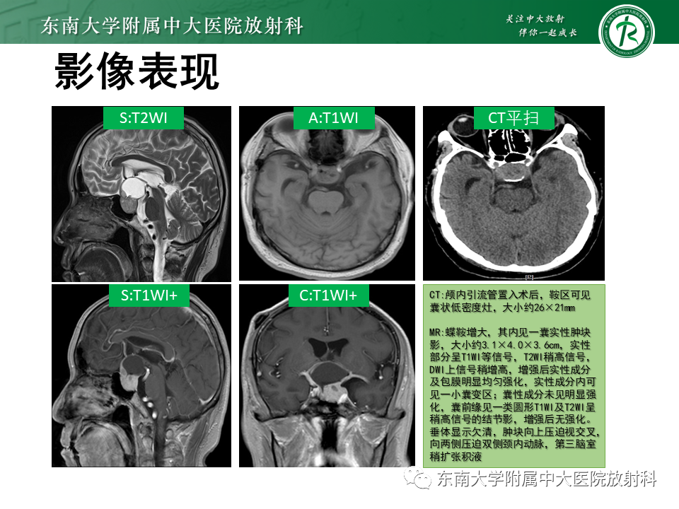 影像PPT - 【PPT】垂体细胞瘤-39