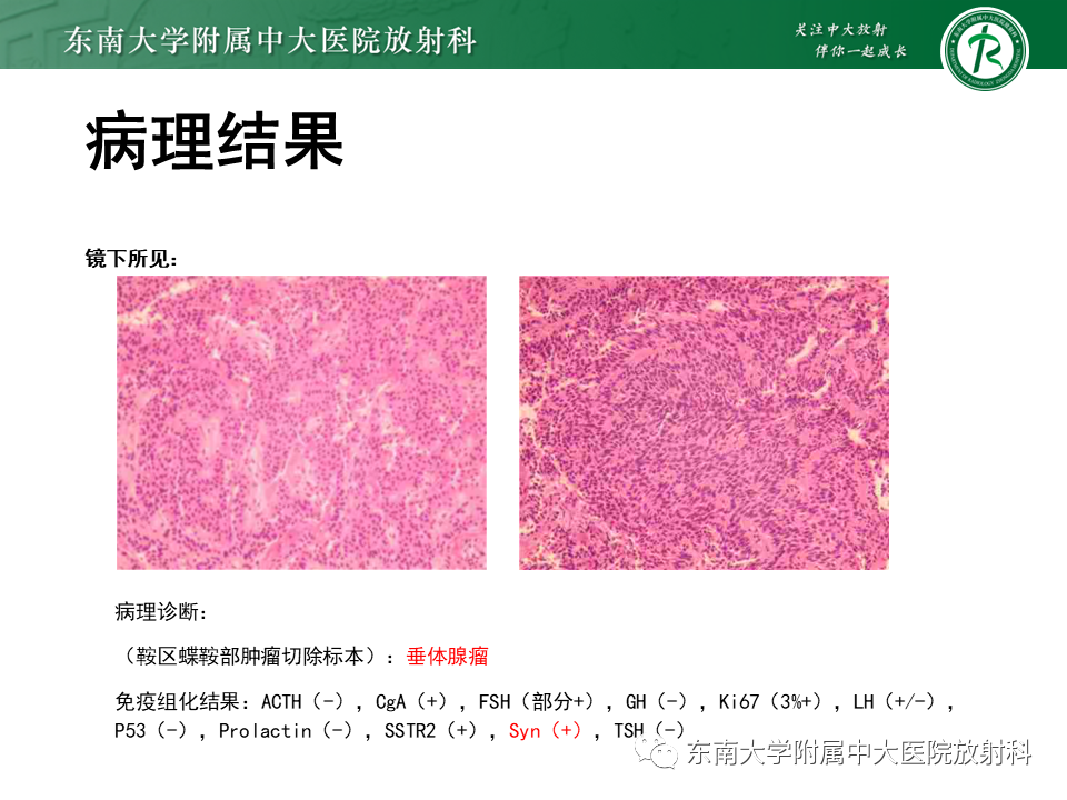 影像PPT - 【PPT】垂体细胞瘤-40
