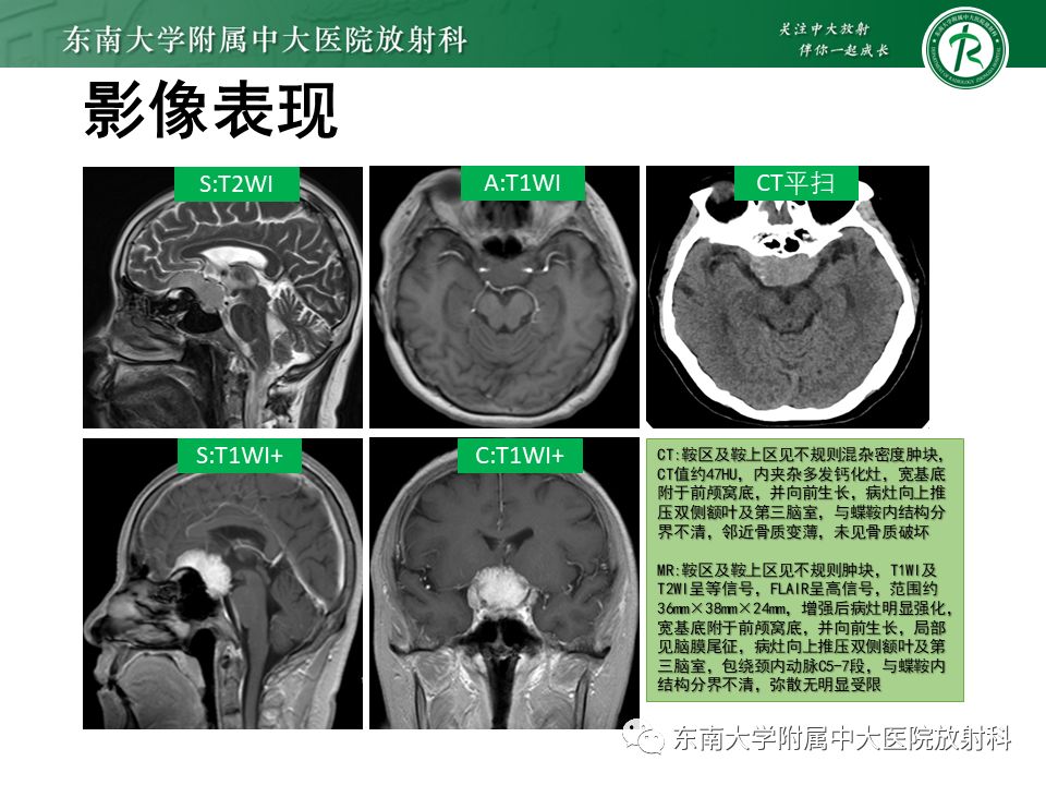 影像PPT - 【PPT】垂体细胞瘤-45