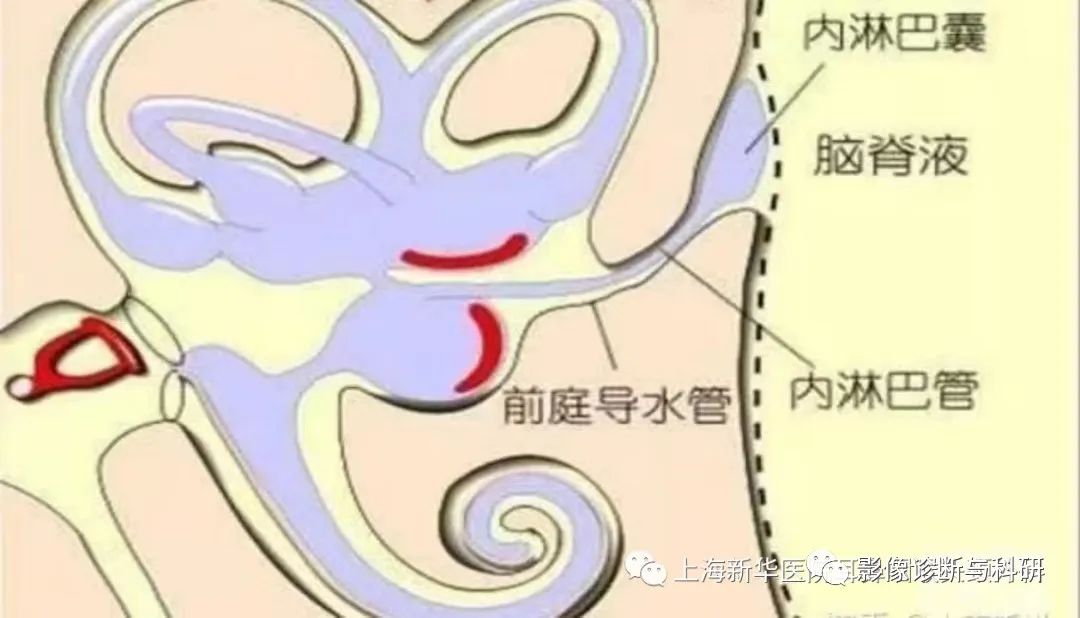 影像PPT - 大前庭导水管综合征-1 影像PPT - 大前庭导水管综合征-1