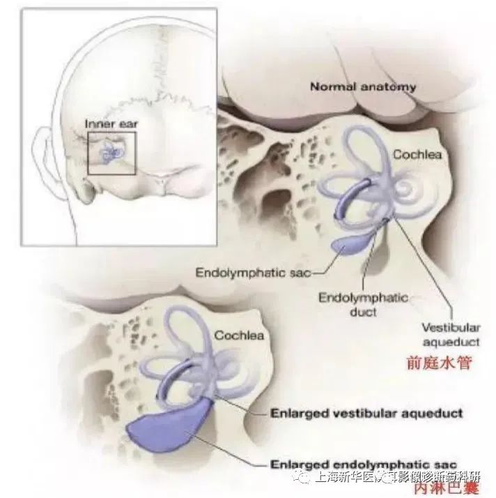 影像PPT - 大前庭导水管综合征-2 影像PPT - 大前庭导水管综合征-2