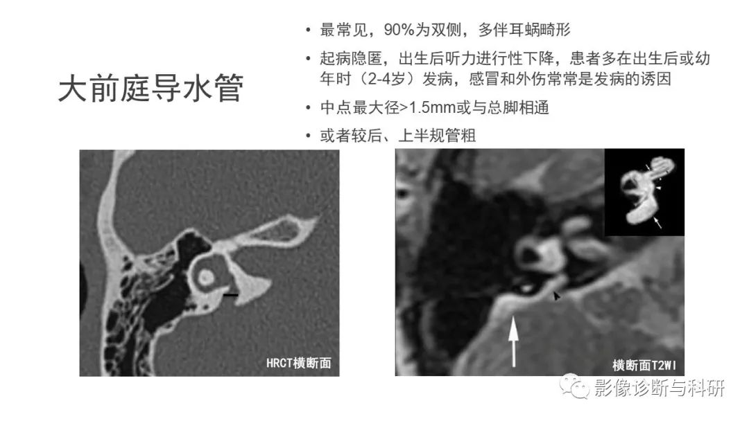 影像PPT - 大前庭导水管综合征-5 影像PPT - 大前庭导水管综合征-5