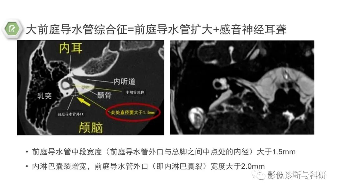 影像PPT - 大前庭导水管综合征-6 影像PPT - 大前庭导水管综合征-6
