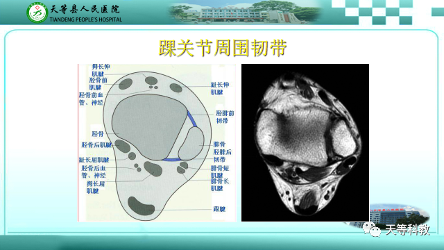 影像PPT - 【PPT】踝关节撞击综合征影像学-6