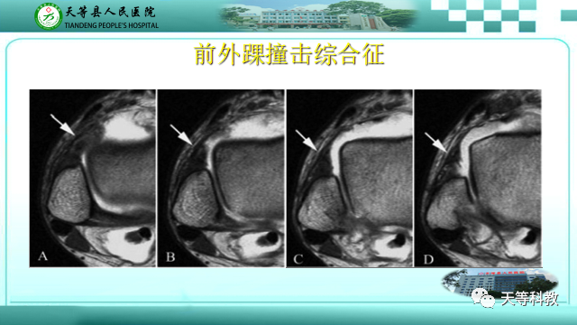 影像PPT - 【PPT】踝关节撞击综合征影像学-11