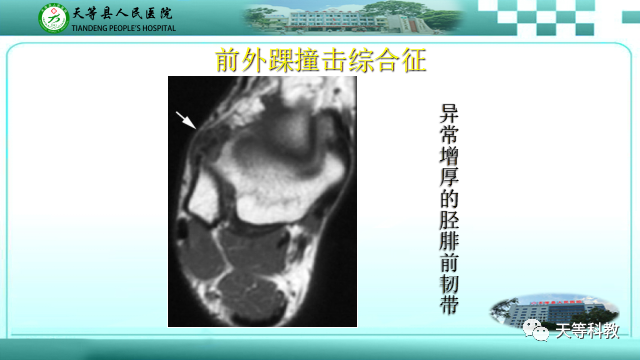 影像PPT - 【PPT】踝关节撞击综合征影像学-12