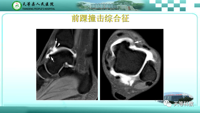 影像PPT - 【PPT】踝关节撞击综合征影像学-17