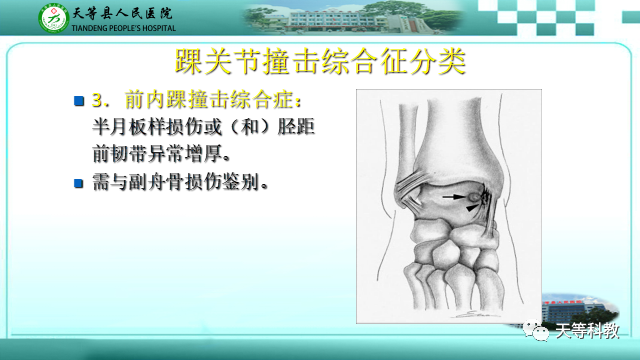影像PPT - 【PPT】踝关节撞击综合征影像学-19