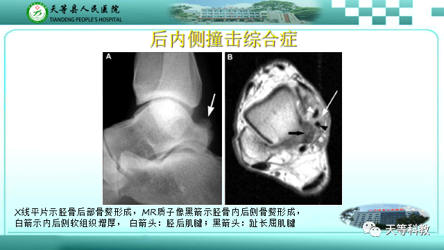 影像PPT - 【PPT】踝关节撞击综合征影像学-24