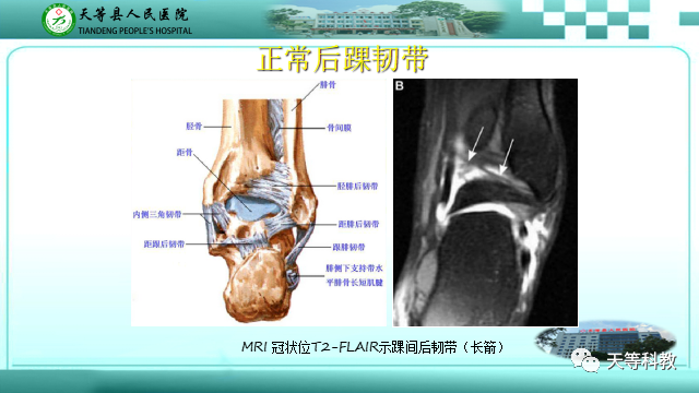 影像PPT - 【PPT】踝关节撞击综合征影像学-26