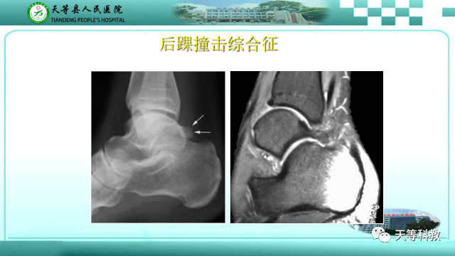 影像PPT - 【PPT】踝关节撞击综合征影像学-28