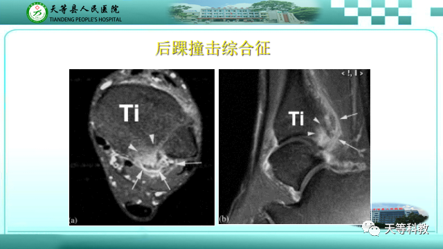 影像PPT - 【PPT】踝关节撞击综合征影像学-29