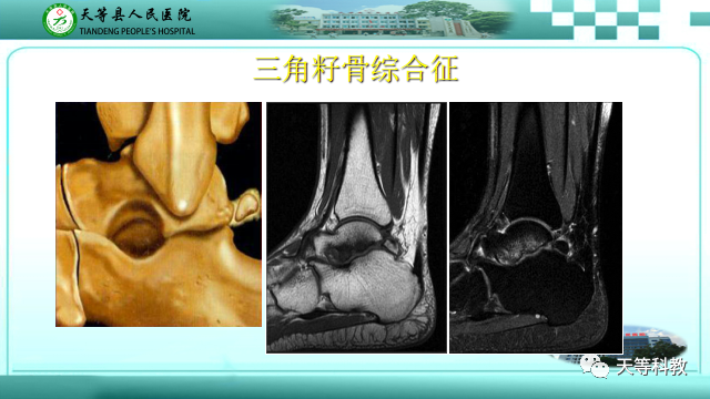 影像PPT - 【PPT】踝关节撞击综合征影像学-37
