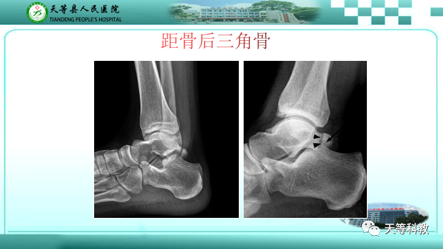 影像PPT - 【PPT】踝关节撞击综合征影像学-39