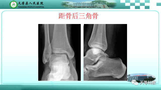 影像PPT - 【PPT】踝关节撞击综合征影像学-40