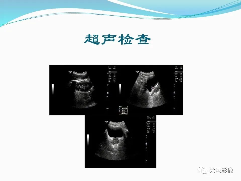 影像PPT - 【PPT】一例输尿管囊肿病例分享-3
