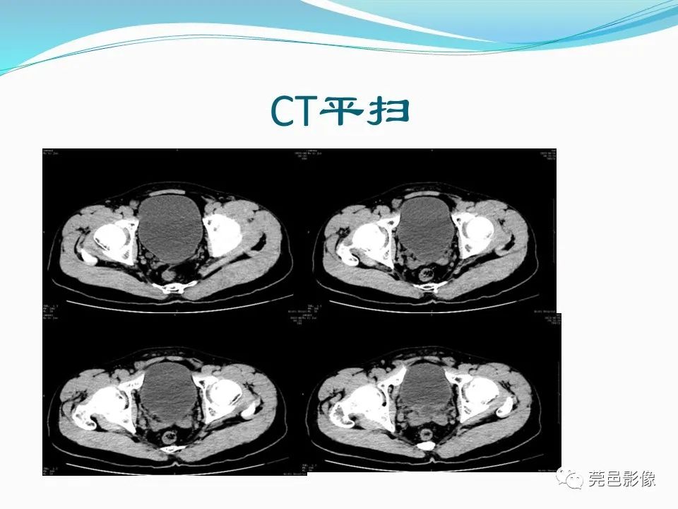 影像PPT - 【PPT】一例输尿管囊肿病例分享-5