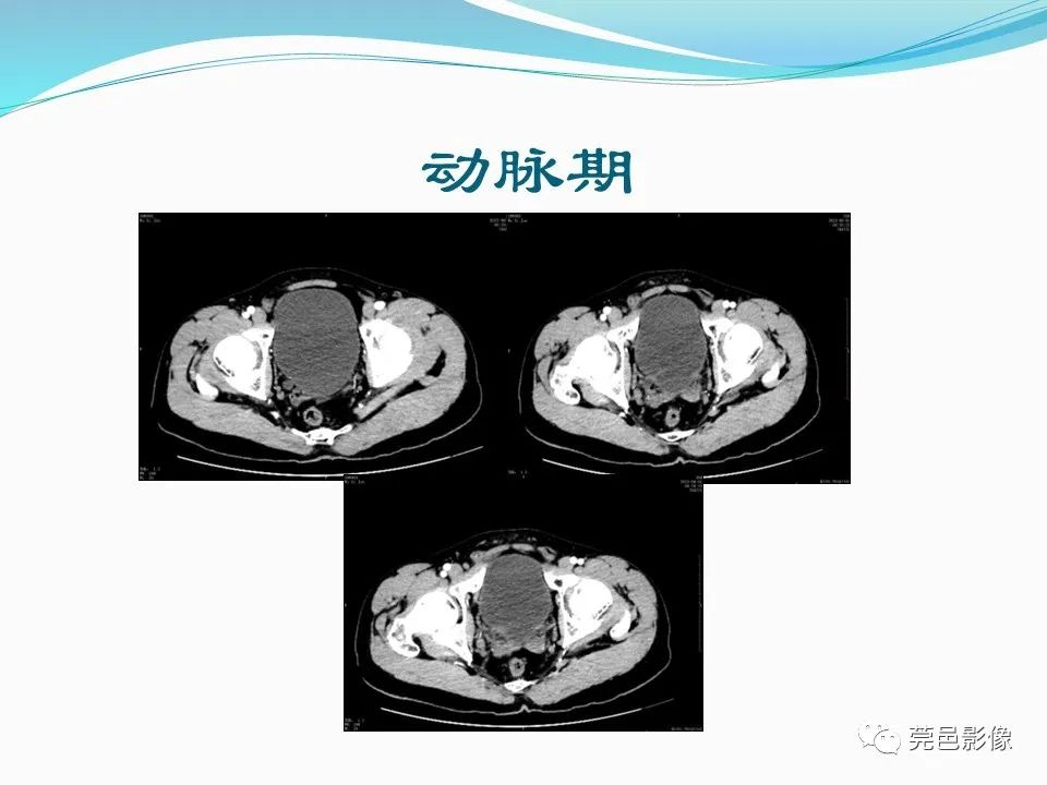 影像PPT - 【PPT】一例输尿管囊肿病例分享-6