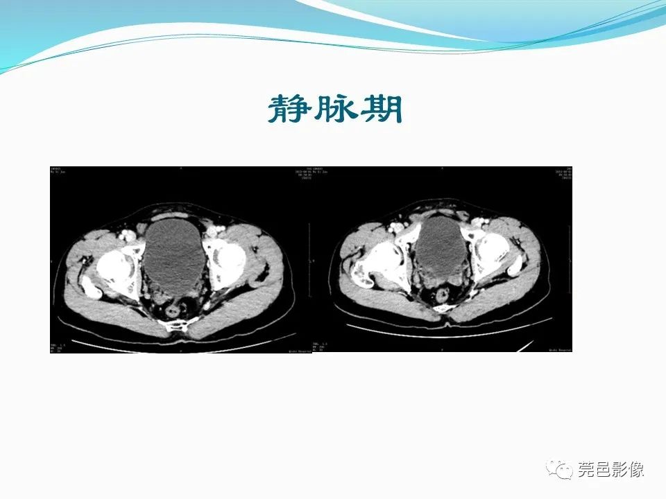 影像PPT - 【PPT】一例输尿管囊肿病例分享-7