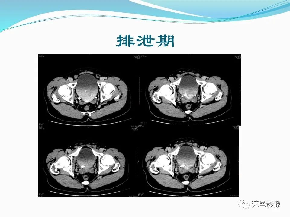 影像PPT - 【PPT】一例输尿管囊肿病例分享-8