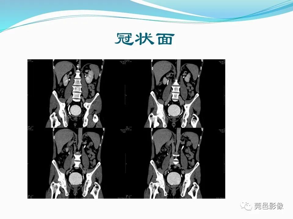 影像PPT - 【PPT】一例输尿管囊肿病例分享-9