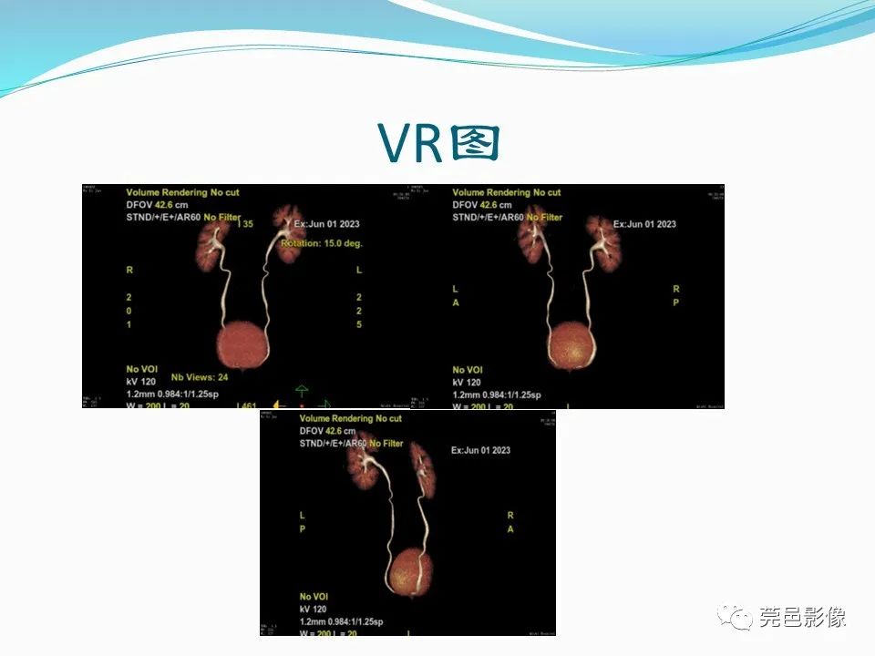 影像PPT - 【PPT】一例输尿管囊肿病例分享-10