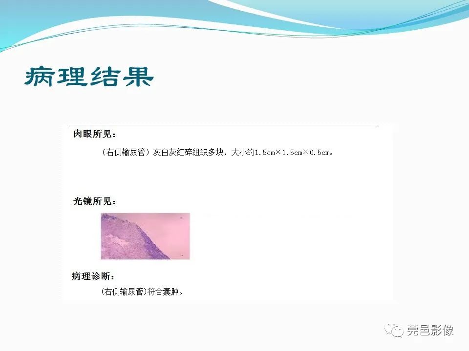 影像PPT - 【PPT】一例输尿管囊肿病例分享-14