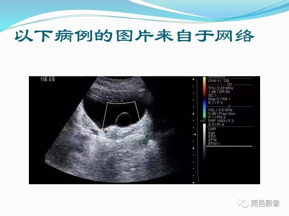 影像PPT - 【PPT】一例输尿管囊肿病例分享-19