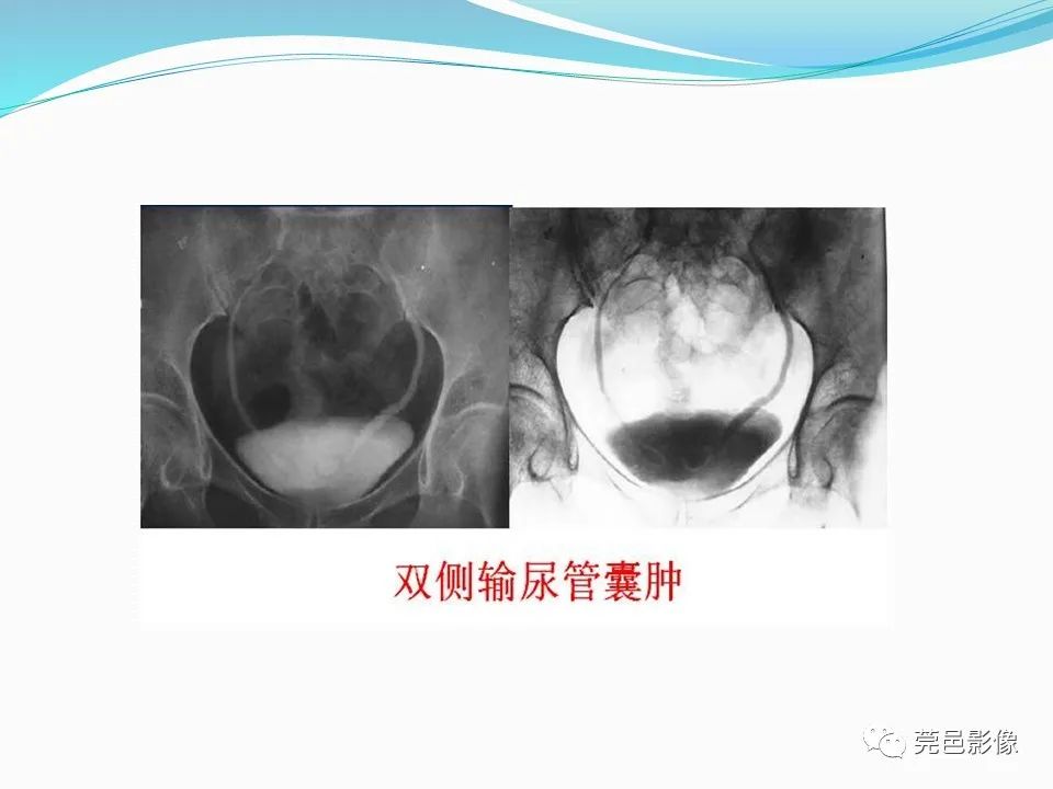 影像PPT - 【PPT】一例输尿管囊肿病例分享-20