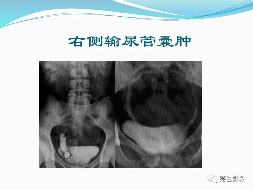 影像PPT - 【PPT】一例输尿管囊肿病例分享-21