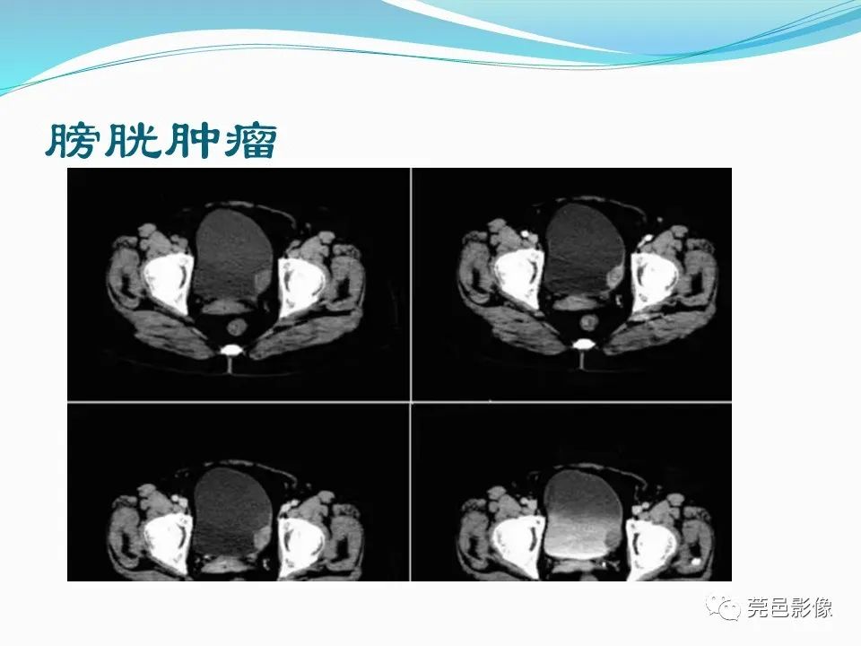 影像PPT - 【PPT】一例输尿管囊肿病例分享-23