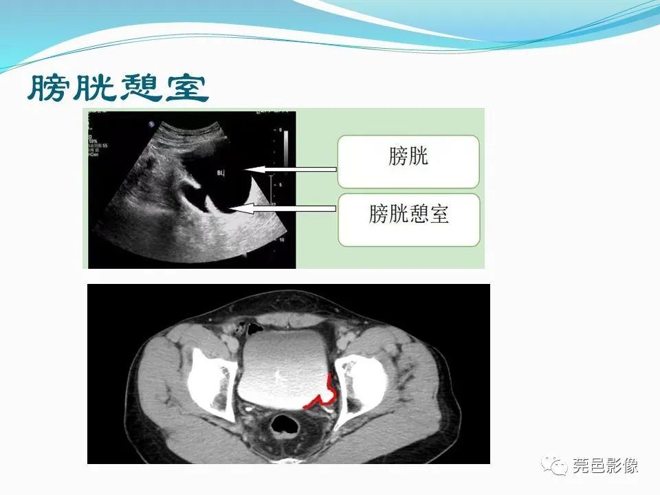 影像PPT - 【PPT】一例输尿管囊肿病例分享-25