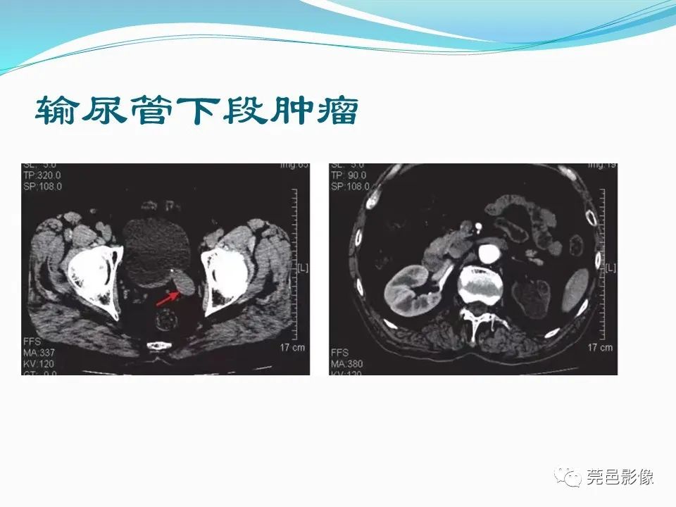 影像PPT - 【PPT】一例输尿管囊肿病例分享-27
