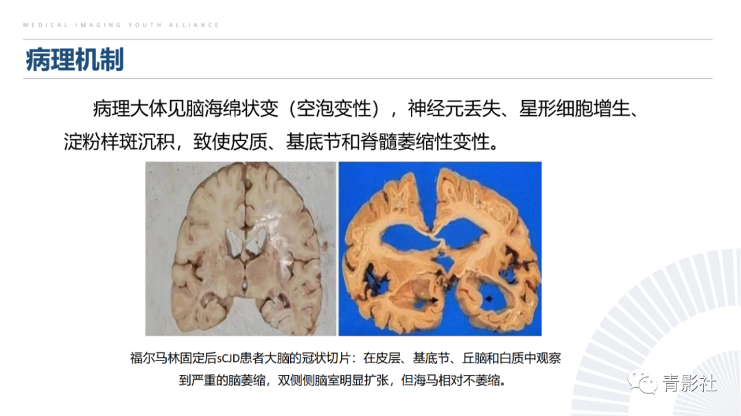 影像PPT - 【PPT】克雅氏病（Creutzfeldt-Jakob Disease）的影像诊断思路-4