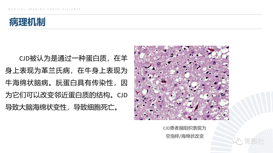 影像PPT - 【PPT】克雅氏病（Creutzfeldt-Jakob Disease）的影像诊断思路-5
