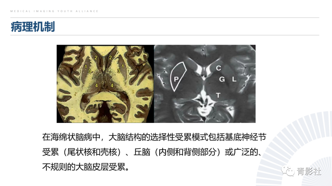 影像PPT - 【PPT】克雅氏病（Creutzfeldt-Jakob Disease）的影像诊断思路-6