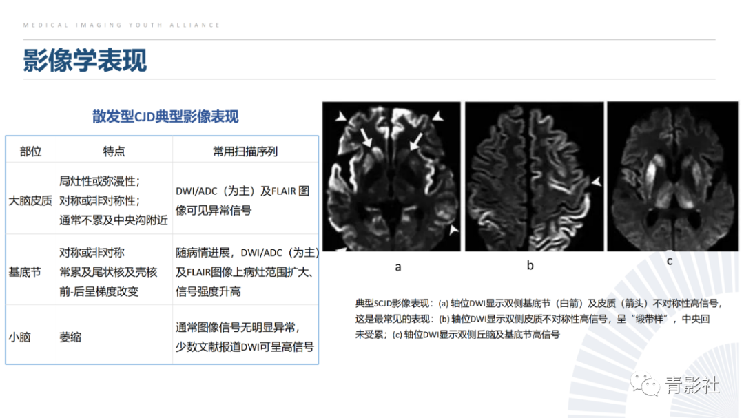 影像PPT - 【PPT】克雅氏病（Creutzfeldt-Jakob Disease）的影像诊断思路-14