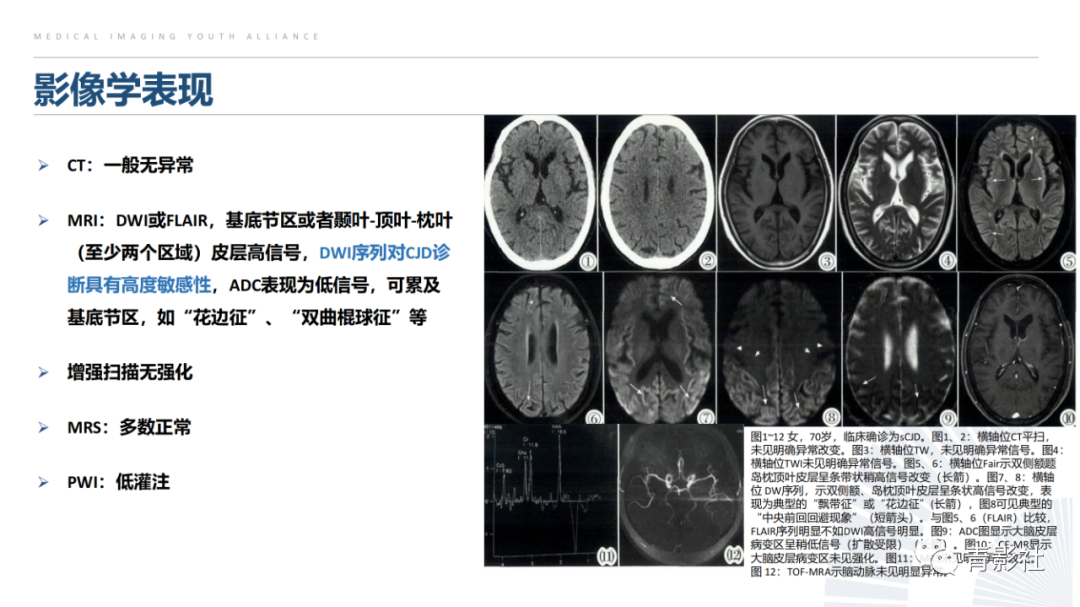 影像PPT - 【PPT】克雅氏病（Creutzfeldt-Jakob Disease）的影像诊断思路-13