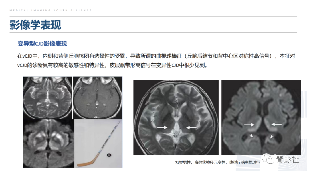 影像PPT - 【PPT】克雅氏病（Creutzfeldt-Jakob Disease）的影像诊断思路-15