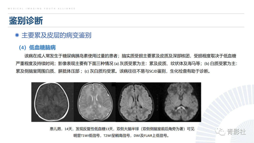 影像PPT - 【PPT】克雅氏病（Creutzfeldt-Jakob Disease）的影像诊断思路-19