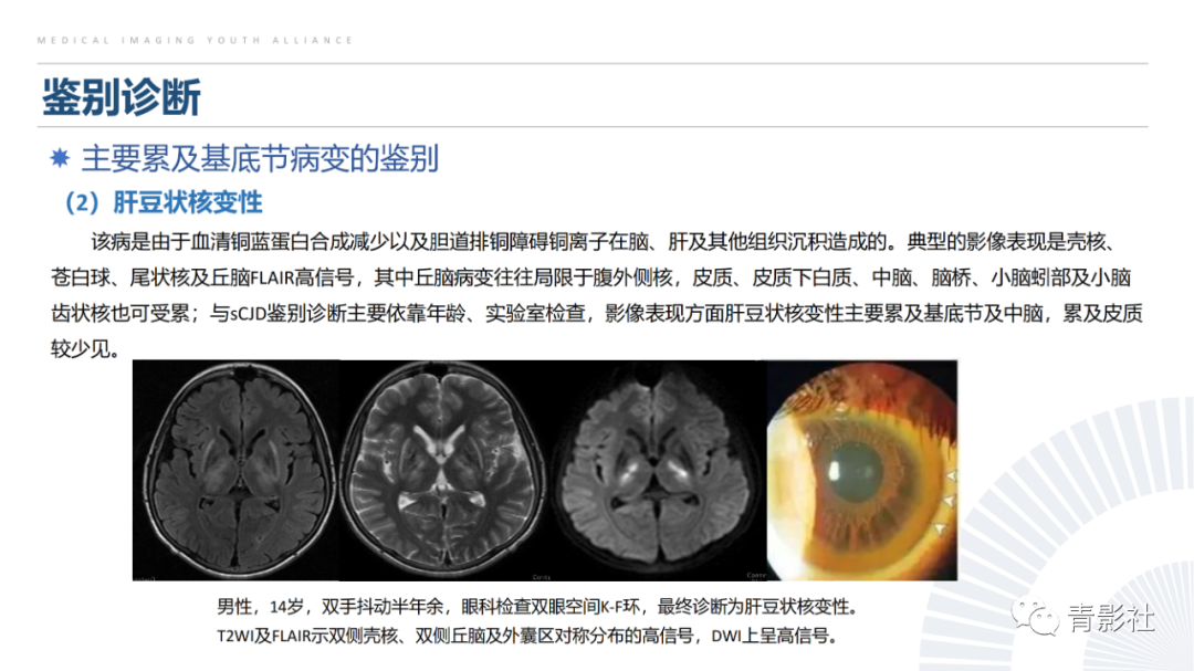影像PPT - 【PPT】克雅氏病（Creutzfeldt-Jakob Disease）的影像诊断思路-22